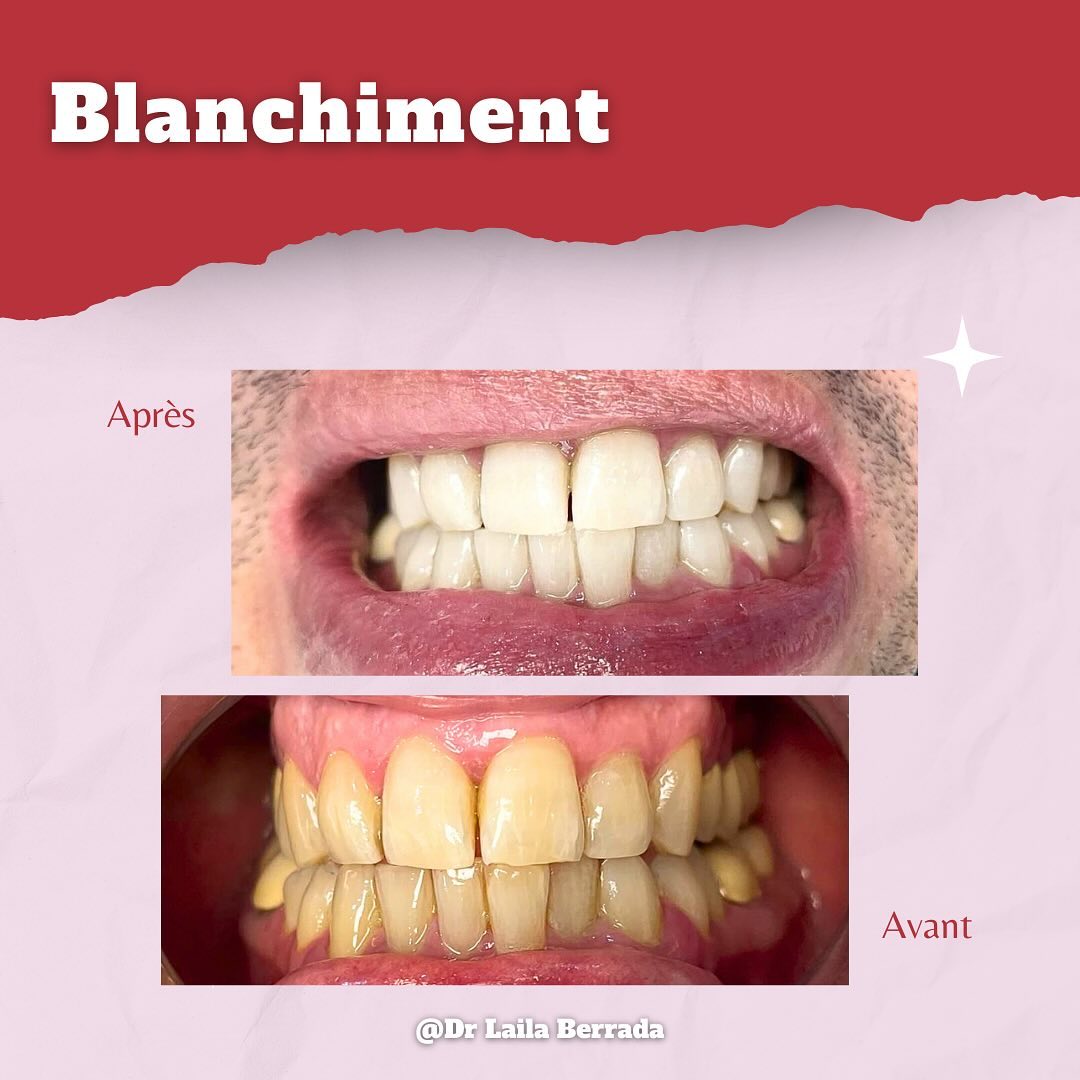 Transformation de sourire - Cas 3